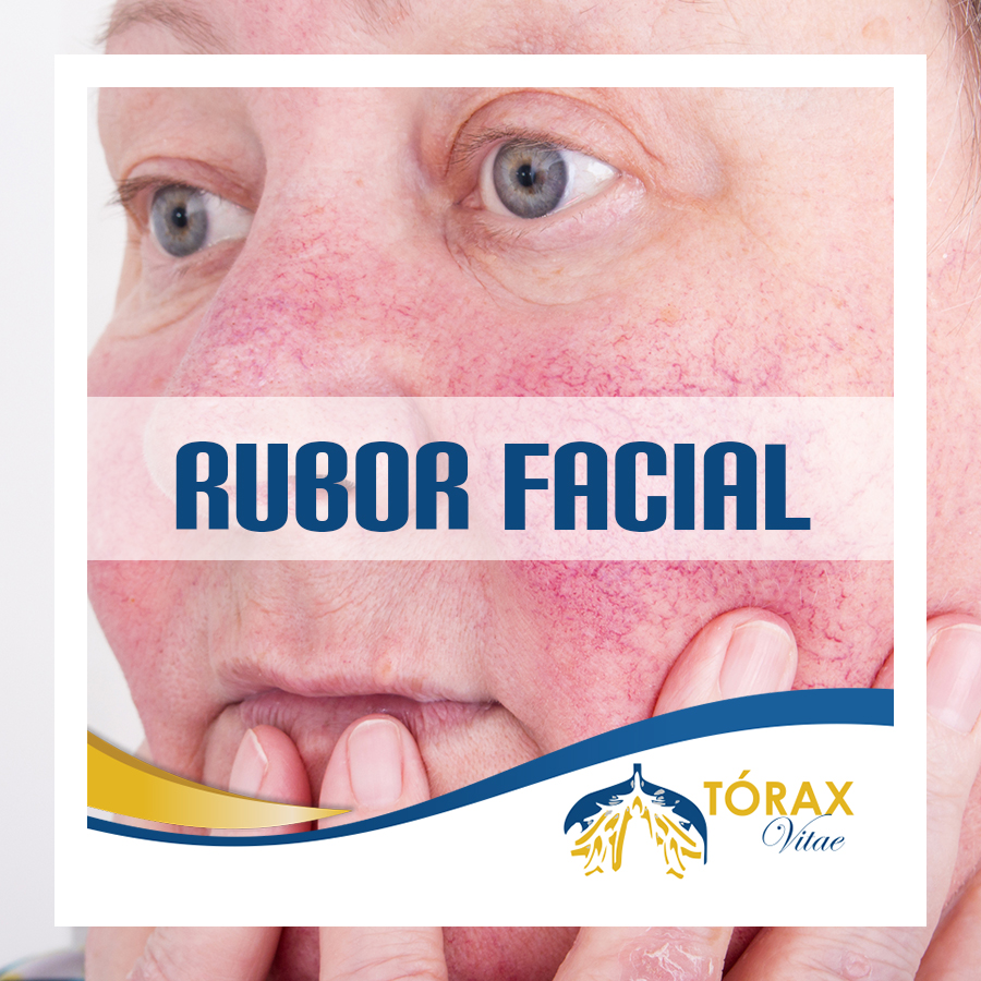 RUBOR-FACIAL.jpg