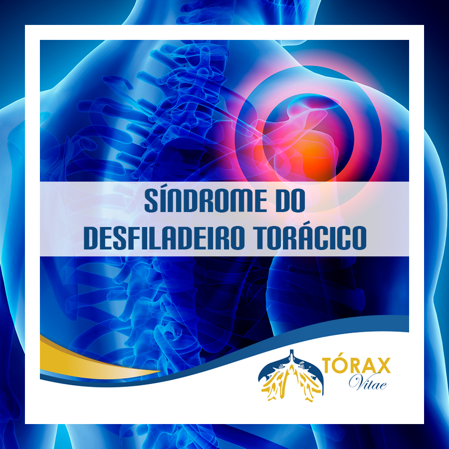 Sindrome-do-Desfiladeiro-Toracico1.jpg